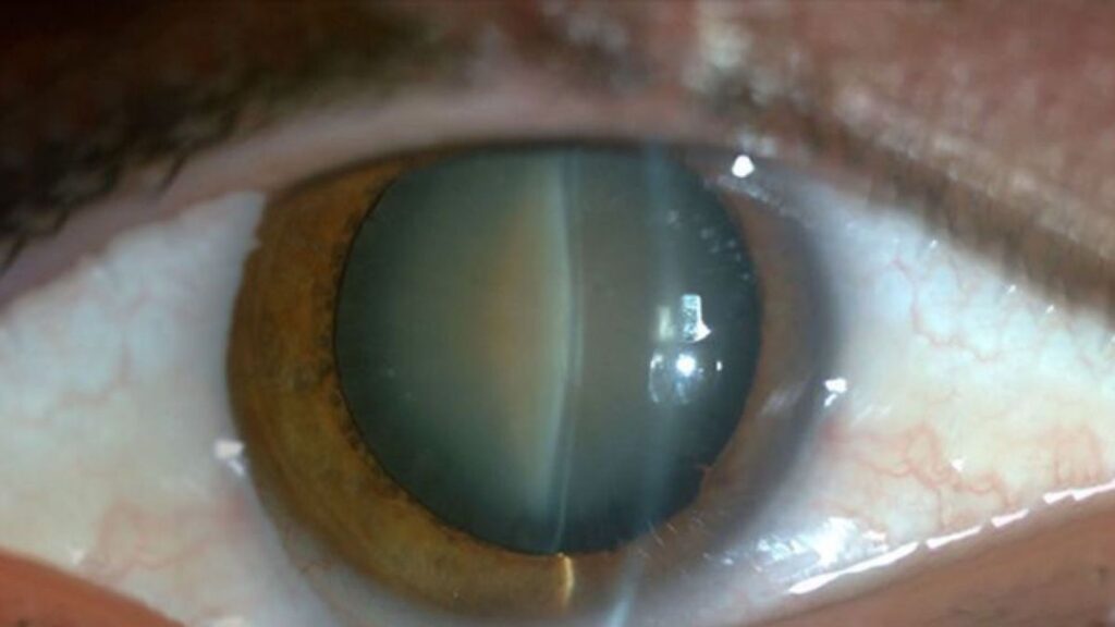 Cataract Treatment